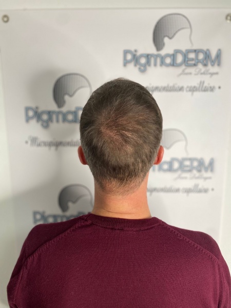 dermopigmentation.jpg